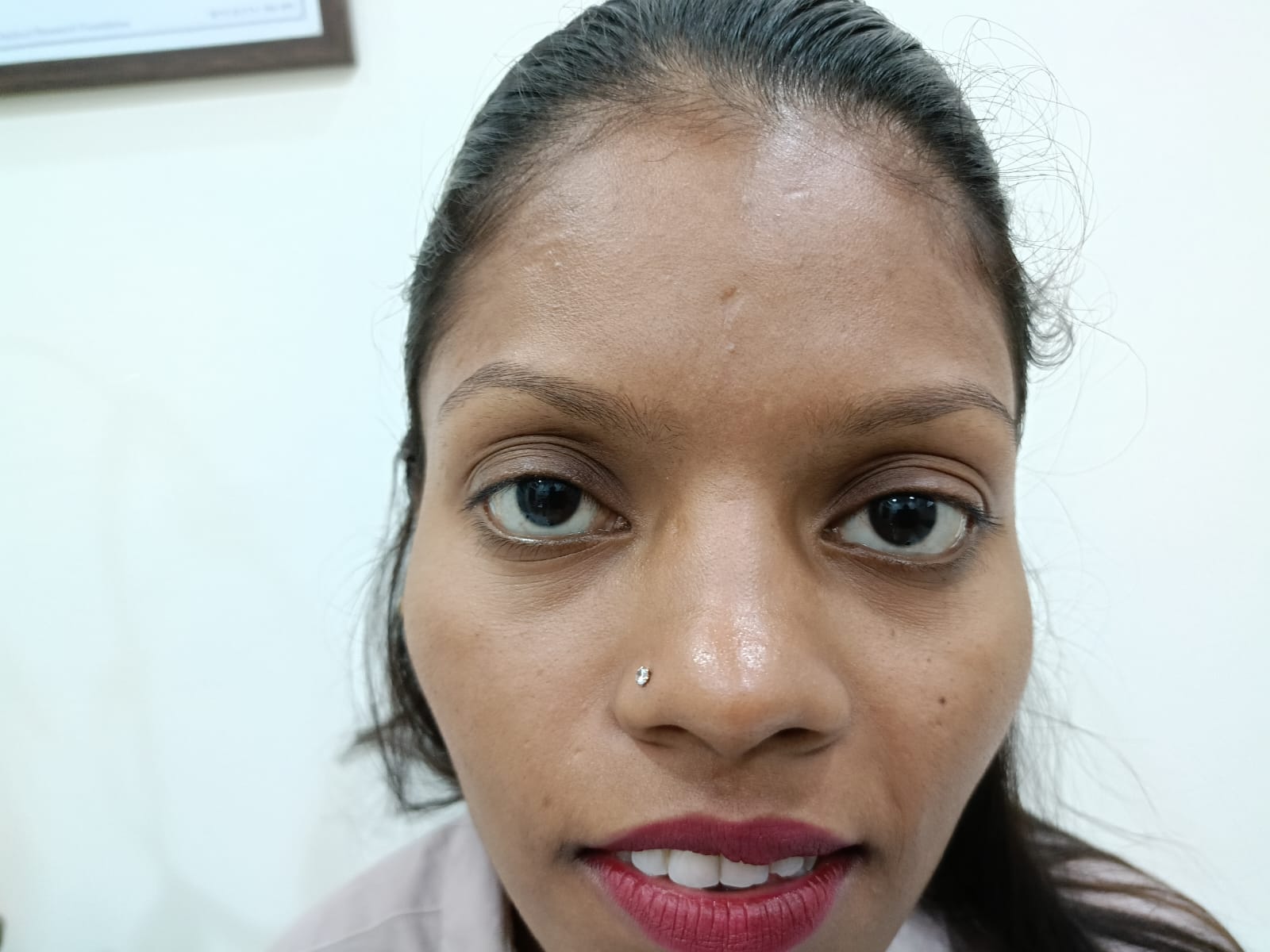 After eye alignment photo