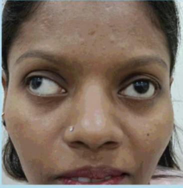 Before eye alignment photo